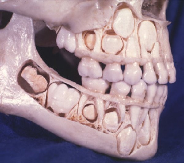 This is what it looks like when someone still have all of their baby teeth.