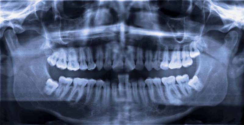 Wisdom teeth are also an evolutionary leftover