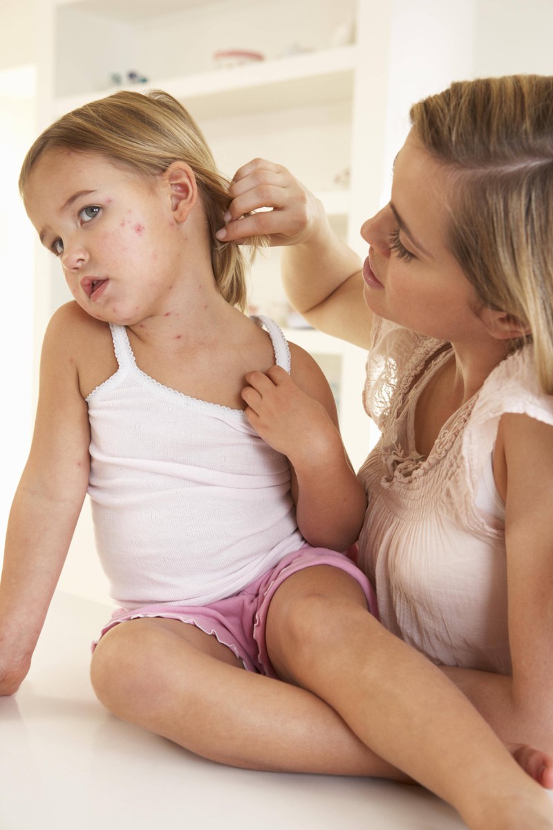 A young girl has pox on her face.