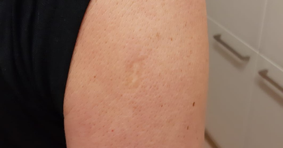 Upper Arm Scar: Many People Have It, But For What Reason?