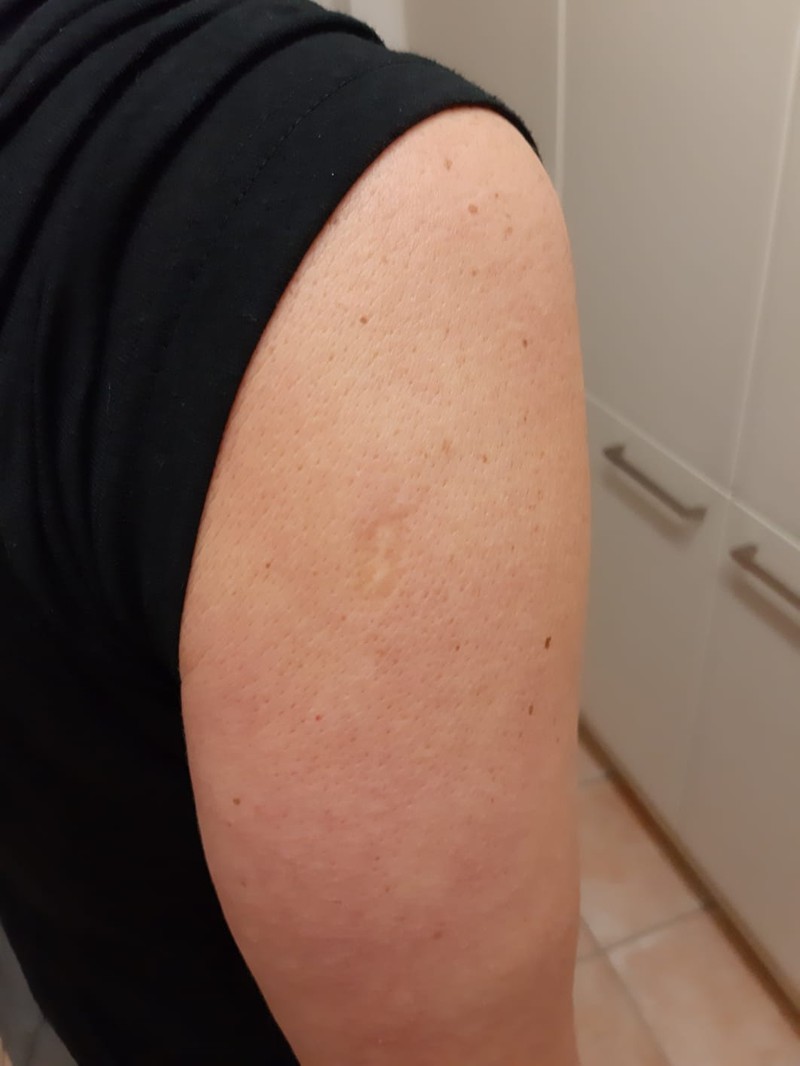 Many people have a scar from the smallpox vaccine on their arm.